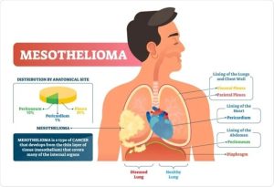 Mesothelioma and the Pericardium