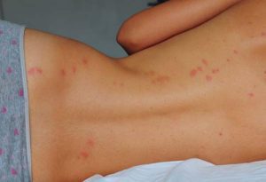 Bed Bug Infestations