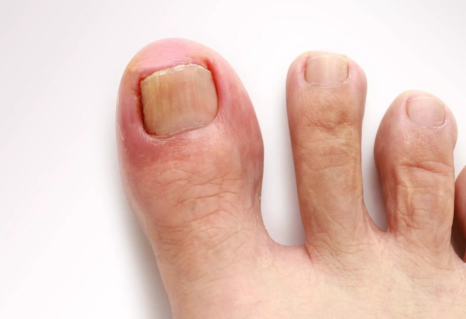 Toenail Discomfort