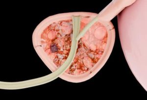 Prostate Cancer