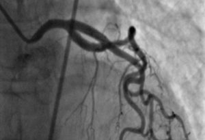 Heart Procedures