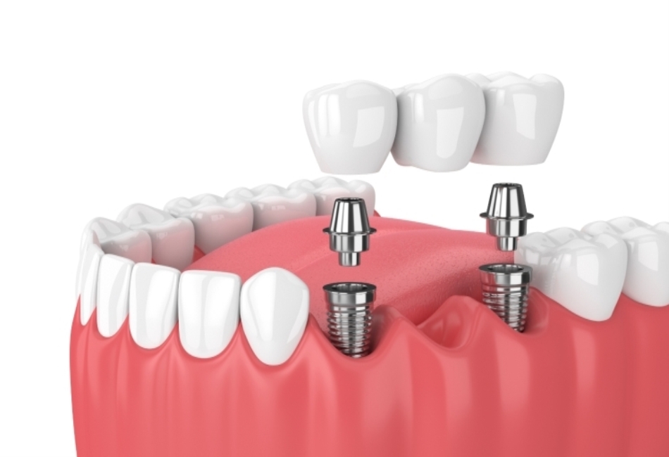 Dental Implant Procedure